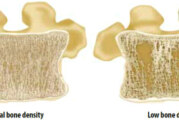 Don’t Wait Until You Have a Fracture to Learn About Osteoporosis