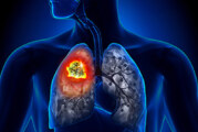 Lung Cancer Screening Can Save Your Life