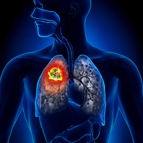 Are You at High Risk for Lung Cancer?