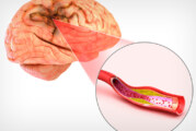 Types of Stroke: What is an Embolic Stroke?
