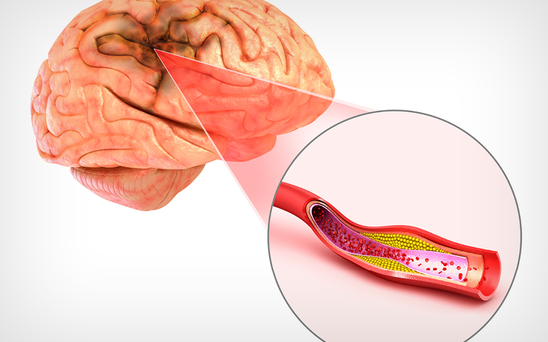 Types of Stroke: What is an Embolic Stroke?