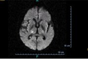 Types of Stroke: What is a Lacunar Stroke?