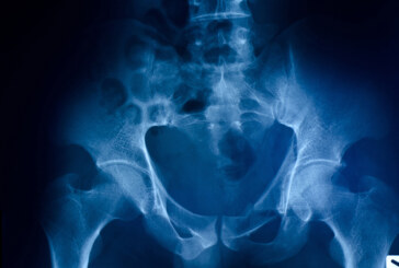 Reproductive Lead Shielding No Longer Needed for X-ray or CT Appointments