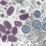 monkeypox-colorized-CDC_blog