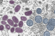 Monkeypox Update—It’s Rare and Not Easily Spread, But Here’s What to Watch For