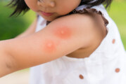 Keep Mosquitoes from Taking a Bite Out of Your Summer Fun