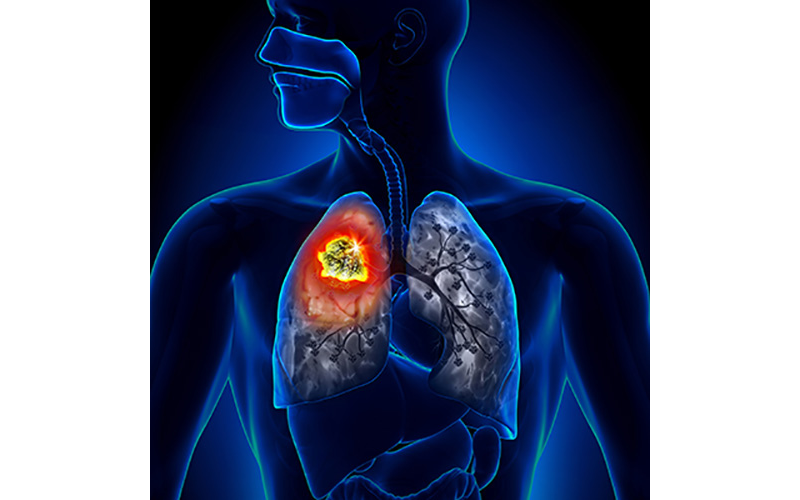 Lung Cancer Screening